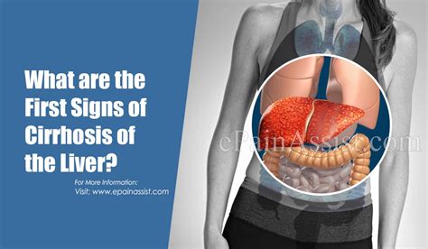 What Are The First Signs Of Cirrhosis Of The Liver