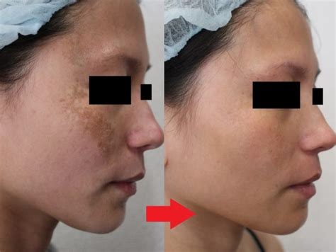 也许您脸上的斑是肝斑？激光祛斑治疗让您恢复完美肌肤！ 最新信息（整形美容） 东京整形美容医院 青山赛俪丝医院（东京，埼玉，千叶）