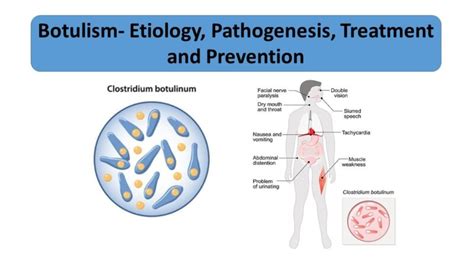Botulism Etiology Pathogenesis Treatment And Prevention