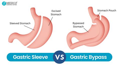 Gastric Sleeve Vs Gastric Bypass Choosing The Right Surgery