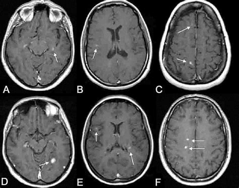 Mri Brain White Spots Cause Mri Scan Images Mri Brain Mri Scan