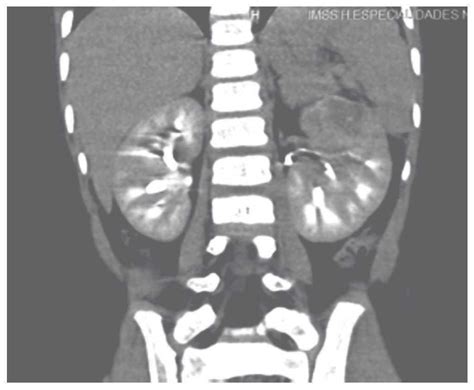 Tumor De Wilms Bilateral Con áreas Focales De Anaplasia Reporte De Un