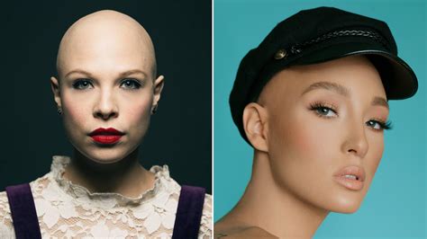 Women With Alopecia On How Hair Loss Affects Self Confidence Allure