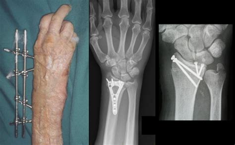 Distal Radius Fracture