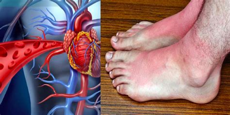 8 Warning Signs Of A Blood Clot That Cant Be Ignored Artikuloblogazine