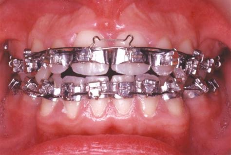 Fully Banded Braces 1980s Eighties Seventies Orthodontics Braces
