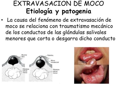 Patologias De Glandulas Salivales