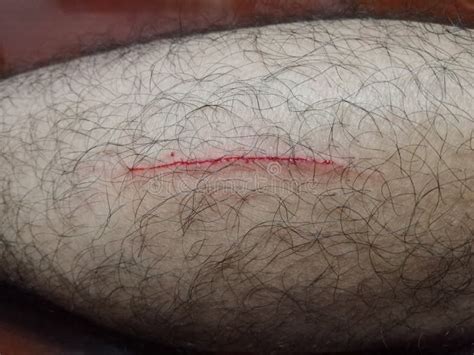 Scratched Wound On Calf Of The Leg Fresh Wounds Stock Image Image