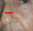 Skin Cancer Nose Treated with Local Flap Repair - Dr. Damian Marucci ...