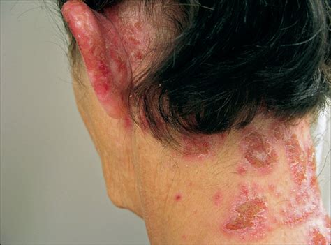Neutrophilic And Eosinophilic Dermatitis Caused By Contact Allergic