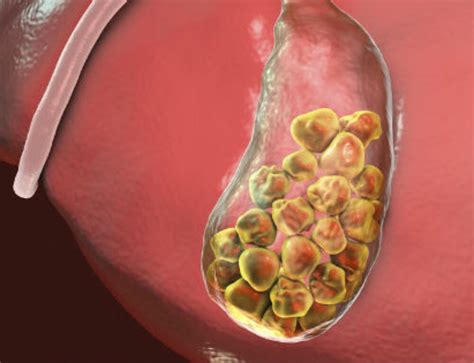Cálculos biliares Síntomas Cirugía Vesícula Biliar
