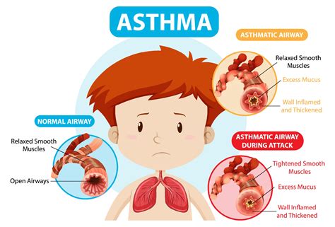 Asthma Diagram With Normal Airway And Asthmatic Airway 3244164 Vector