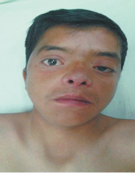 Figure1 Noonan Syndrome Patient With Anti Mongoloid Palpebral Slant