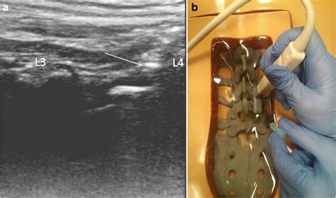 Sagittal Paramedian Approach To Us Guided Lumbar Puncture A