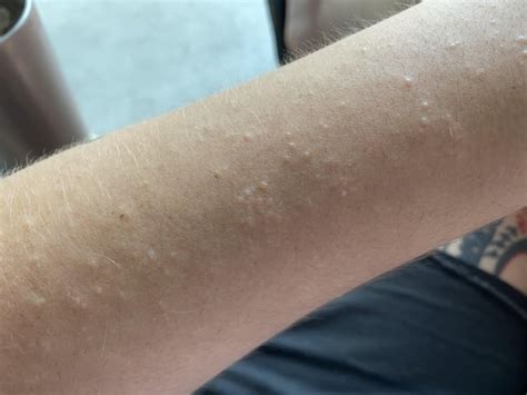 clusters of small bumps on my arm r dermatologyquestions