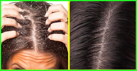 Symptoms Of Dandruff Its Types Causes And How To Treat It