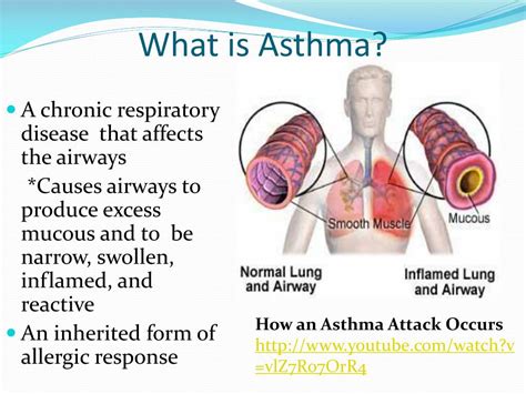 Ppt Asthma Powerpoint Presentation Free Download Id2067579