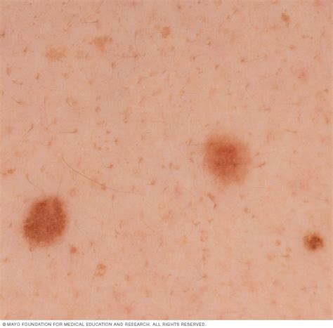 Moles Symptoms And Causes Mayo Clinic
