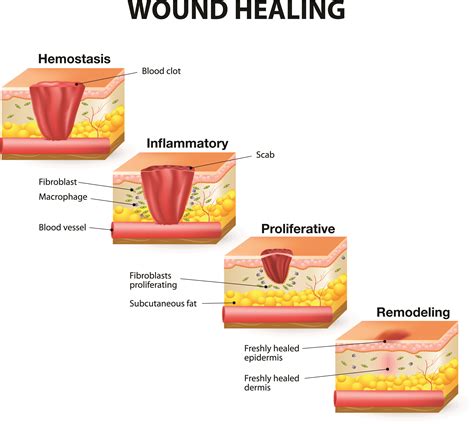 How Wounds Heal The 4 Main Phases Of Wound Healing Shield Healthcare