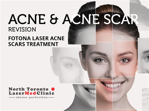 Fotona Laser Acne Scars Treatment North Toronto Laser Med Clinic