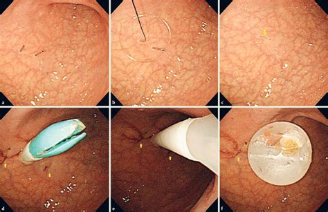 Endoscopic Imaging Of Tube Insertion Using The New