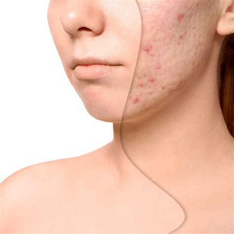 Scar Removal Malaysia Scars Treatment Service At Pj True Clinic