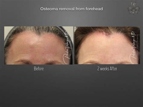 Forehead Osteoma Removal Case 4731 New Orleans Premier Center For