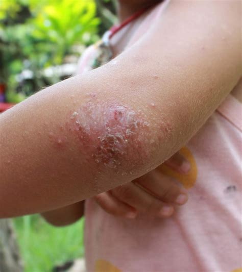 Psoriasis In Children Symptoms Types And How To Deal With It Momjunction