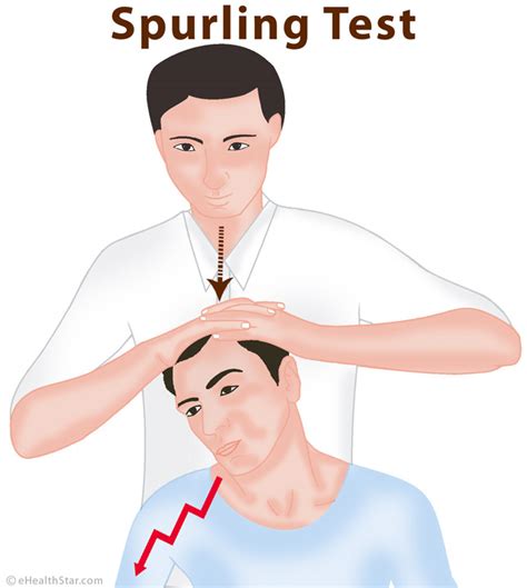 Spurlings Test Or Cervical Axial Compression Test Ehealthstar