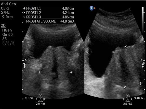 Figure 1 From Effectiveness Of Transabdominal Ultrasonography In