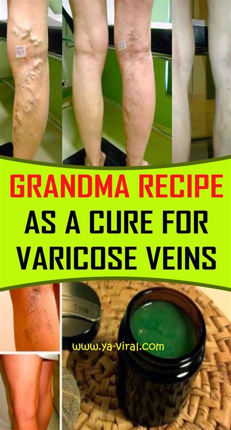 Grandma Recipe As A Cure For Varicose Vein Articleremedies13