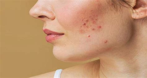 Pimple Scars How To Remove Scars From Acne And Pimples