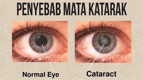 Penyakit Mata Katarak Hermbirkinbiz