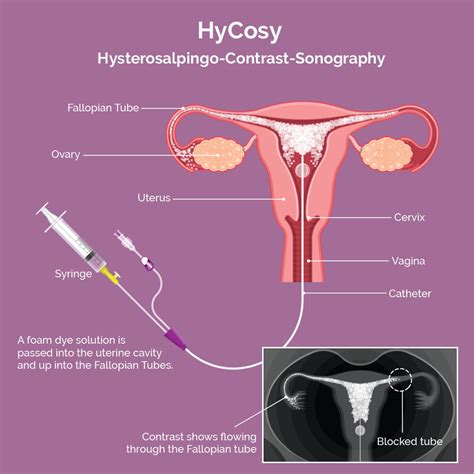 HyCoSy Scan Is A Special Type Of Scan Used To Assess The Fallopian Tubes