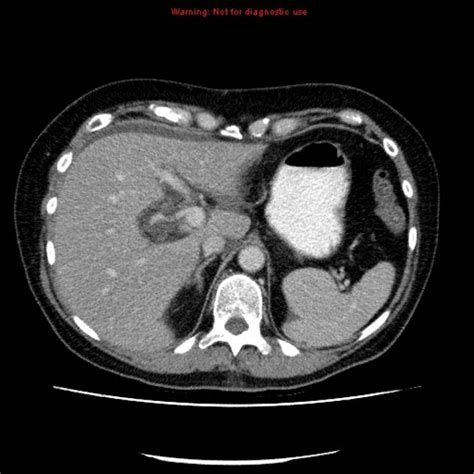 Acute Cholecystitis Radiology Case