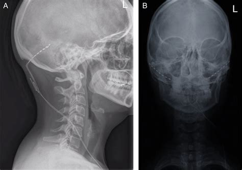Skull X Rays Showing Occipital Nerve Stimulation Electrode Placement