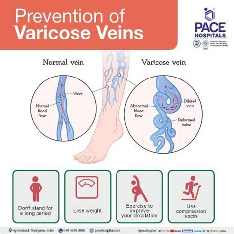 Varicose Veins Symptoms Causes Complications And Treatment