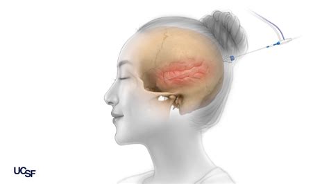 Minimally Invasive Epilepsy Surgery Cutting Edge Treatments MyEpilepsyTeam