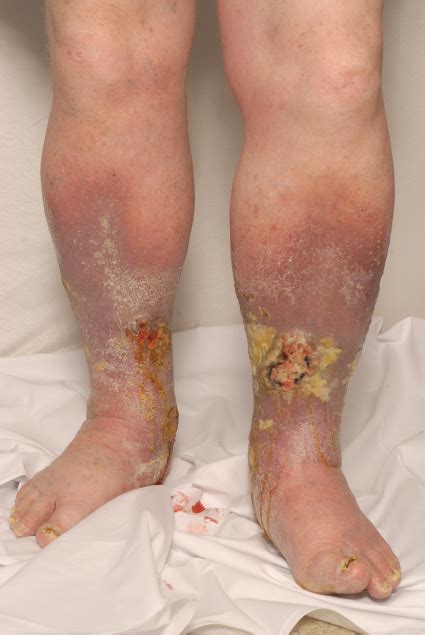 Venous Stasis And Venous Ulceration Lower Extremity Venous Disease My