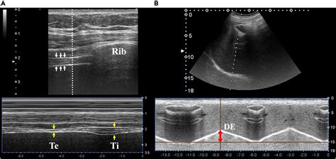 Frontiers Point Of Care Application Of Diaphragmatic Ultrasonography