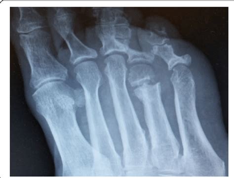 Minimally Invasive Floating Metatarsal Osteotomy Post Operative X Ray