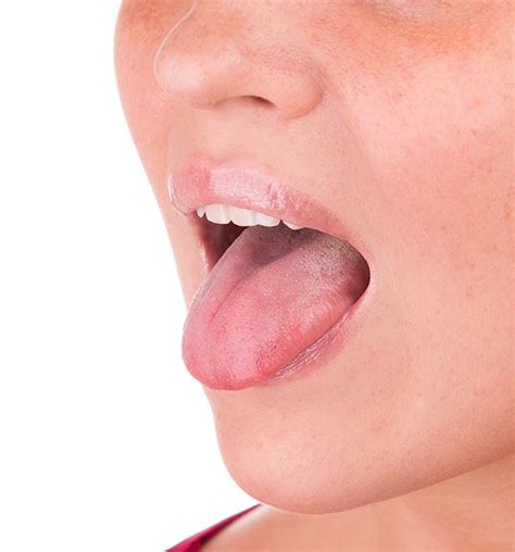 Does Hiv Have A Detrimental Effect On Tongue Health