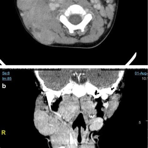 A B Multiple Large Lobulated Ln Seen In The Bilateral Cervical Region