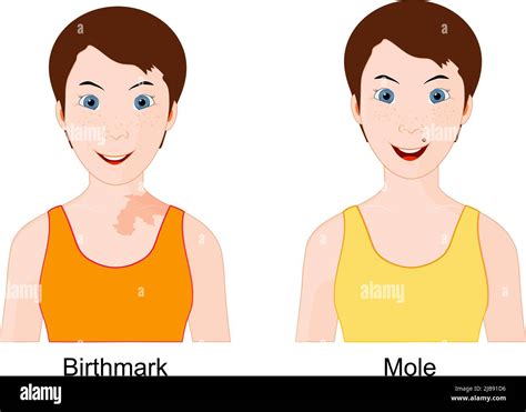 Mole And Birthmark Comparison And Difference For Example Of Two Young