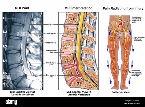 Low Back Pain L4 5 And L5 S1 Lumbar Injuries Stock Photo Royalty