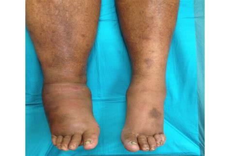 Type 2 Diabetes Leg Swelling Sciencehub