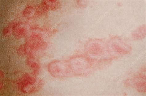 Urticaria Rash On The Skin Stock Image C0130860 Science Photo
