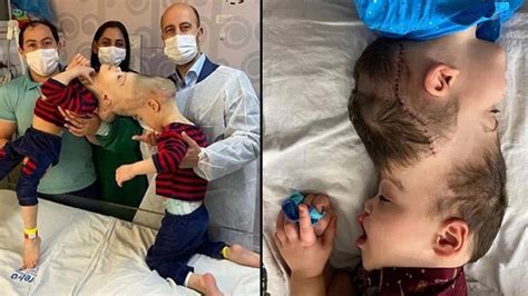 Conjoined Twins With Fused Brains Separated By Uk Doctor In Remarkable