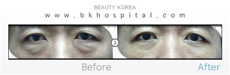 Eyelid Surgery Legend Dr Kim Byung Gun Bk Plastic Surgery Hospital
