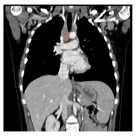 Computed Tomography Scan Showed Mediastinal And Axillary Lymph Nodes Up